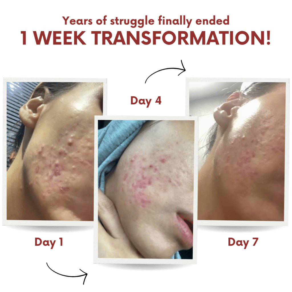 Acne Transformation